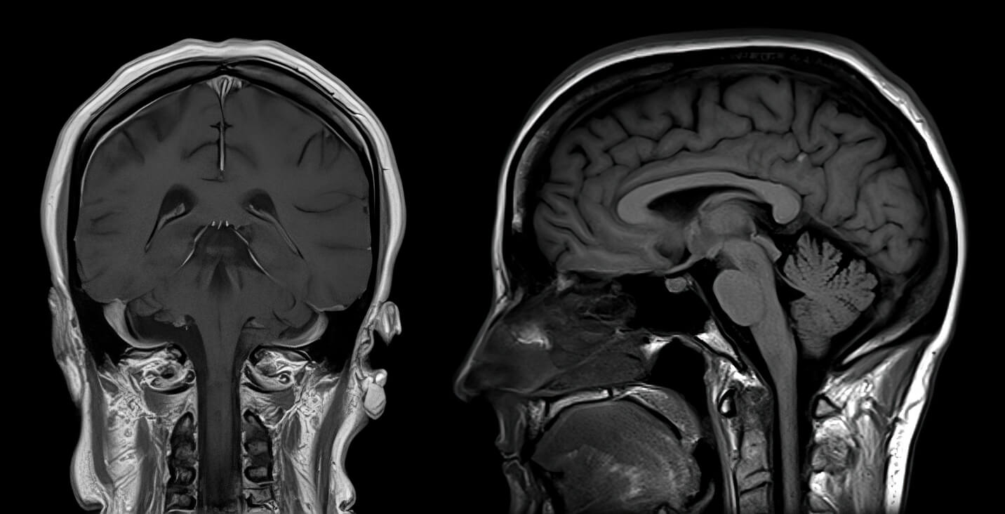 Cerebral Palsy Brain Scan Comparison Cerebral Palsy Brain Scan Comparison